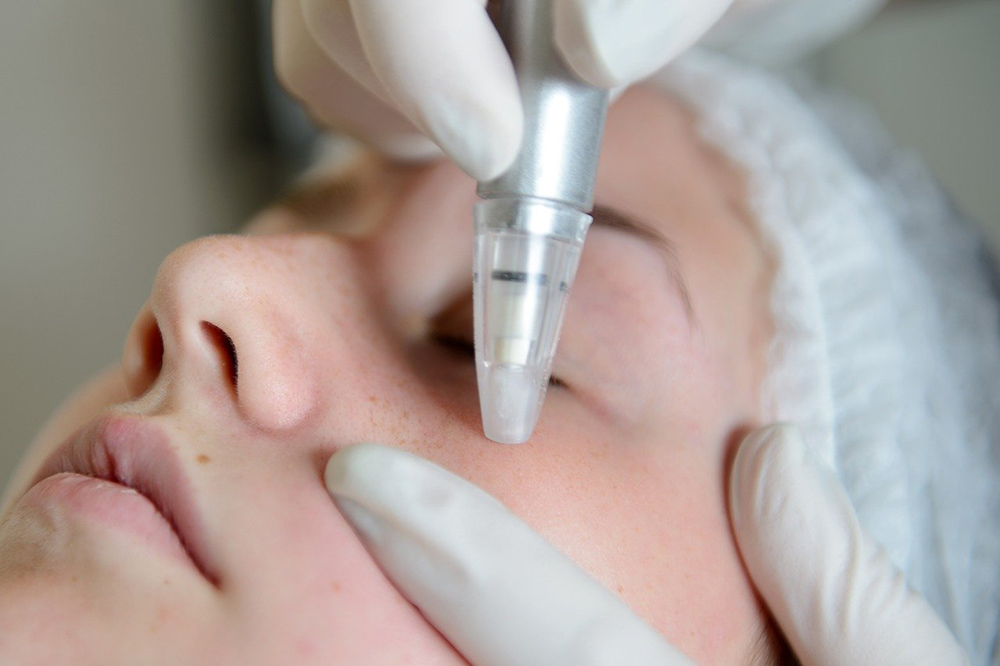 microdermabrasion image