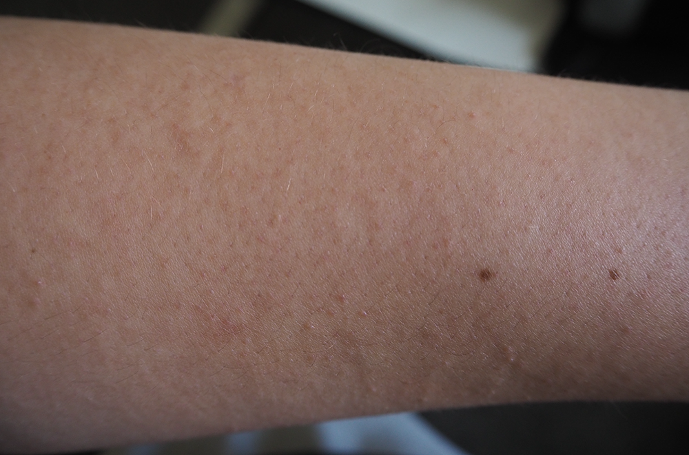 DERMAFLASH Mini before image