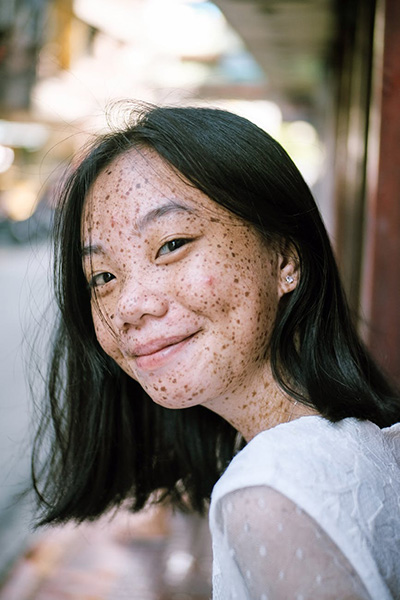 Woman with acne image