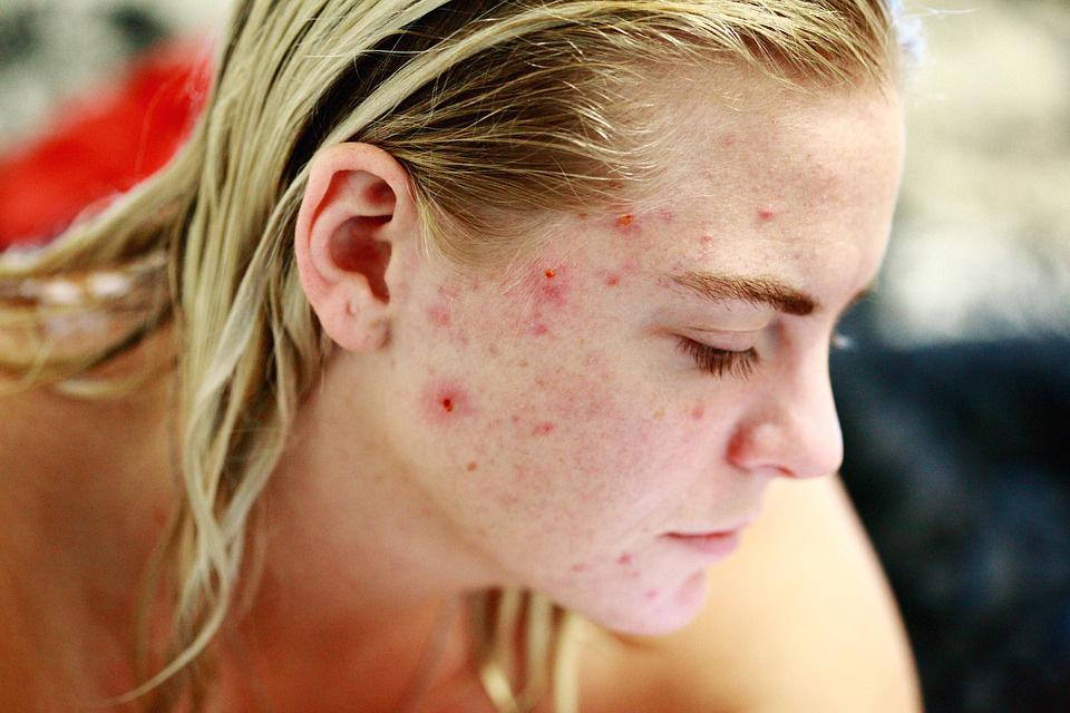 Girl with acne image
