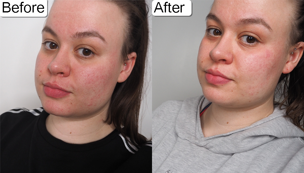 Dermatica rosacea treatment before and after photo image