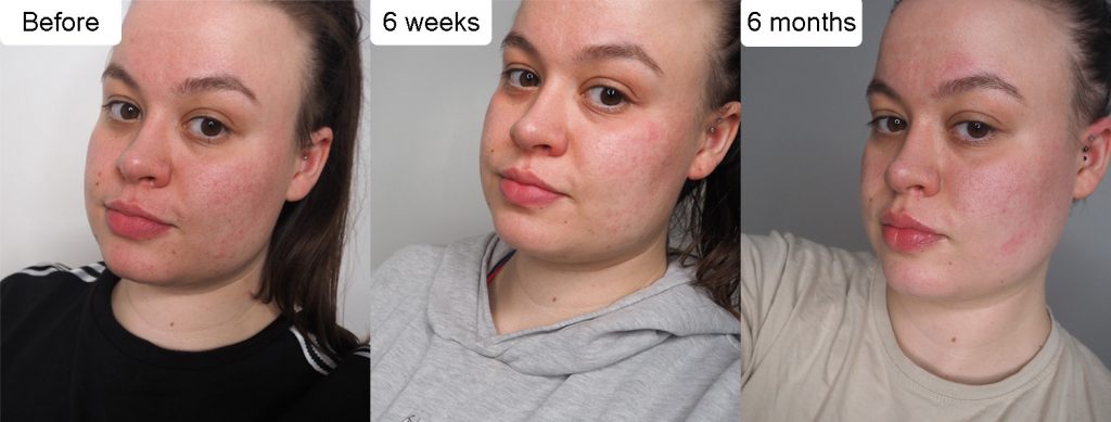 Dermatica 6-month progress photos image