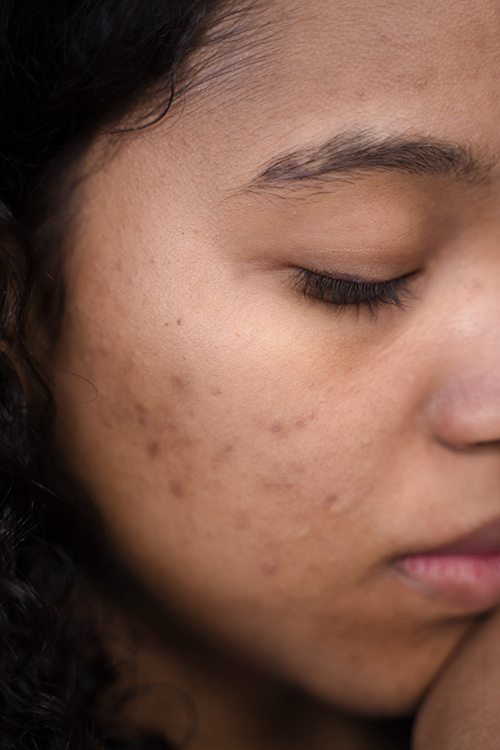 Acne-prone skin image