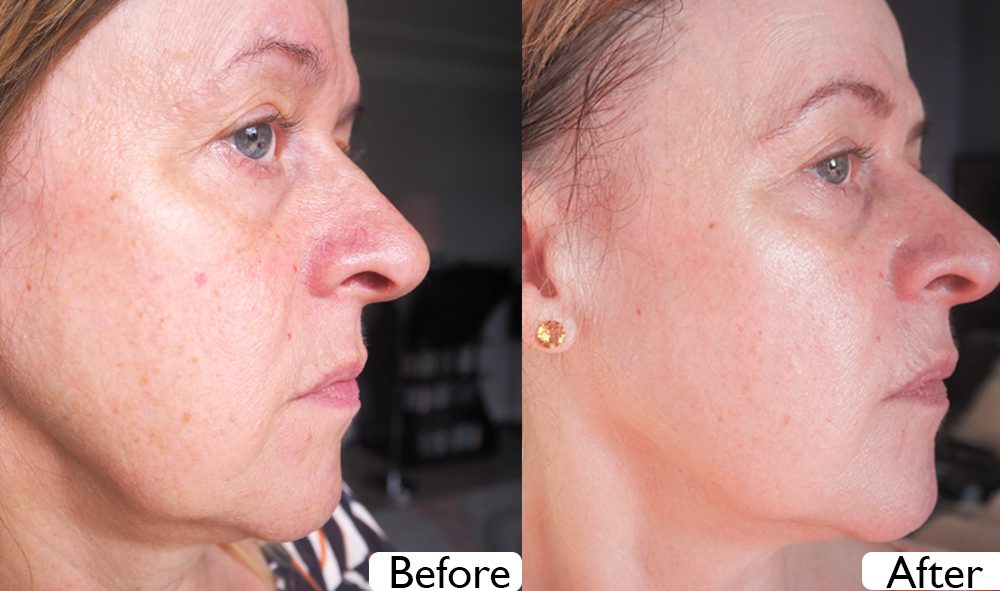 CurrentBody Skin RF Radio Frequency Skin Tightening Device before and after image