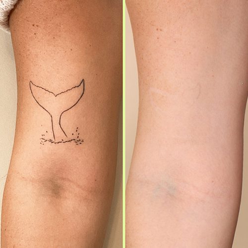 NAAMA Studios laser tatto removal before and after image