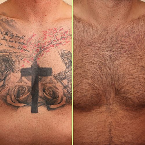 NAAMA Studios laser tatto removal before and after image