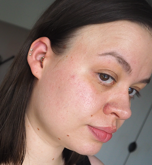 Norse Organics Complete Acne Killer System 2.0 review image